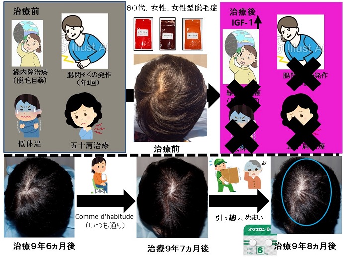 円形脱毛症　病院